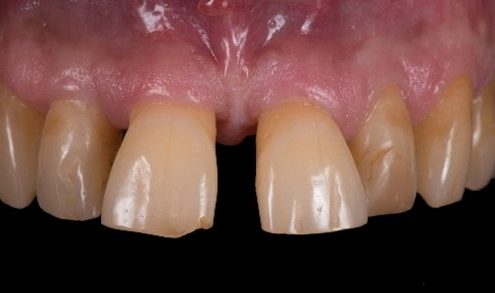 Zahnlücken entstehen durch tiefreichende Zahnerkrankungen.